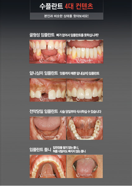 수플란트 4대 컨텐츠