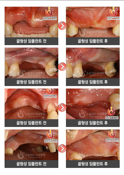 골형성임플란트