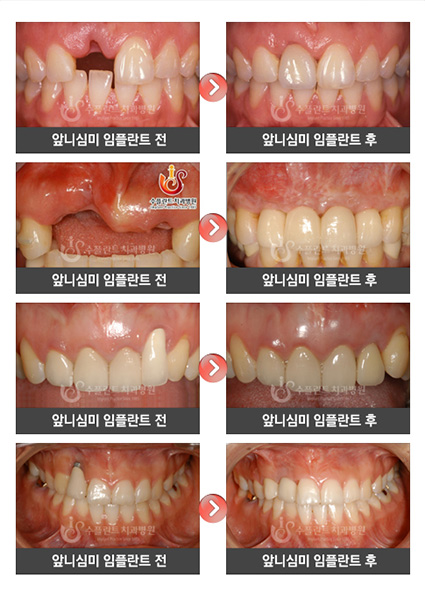 앞니심미임플란트