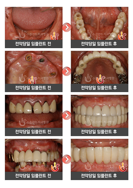 전악당일임플란트