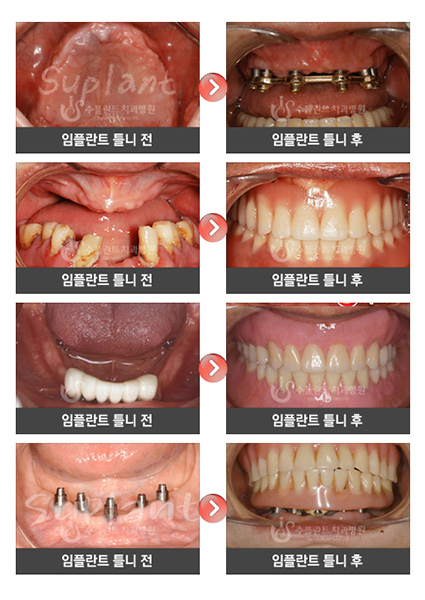 임플란트틀니